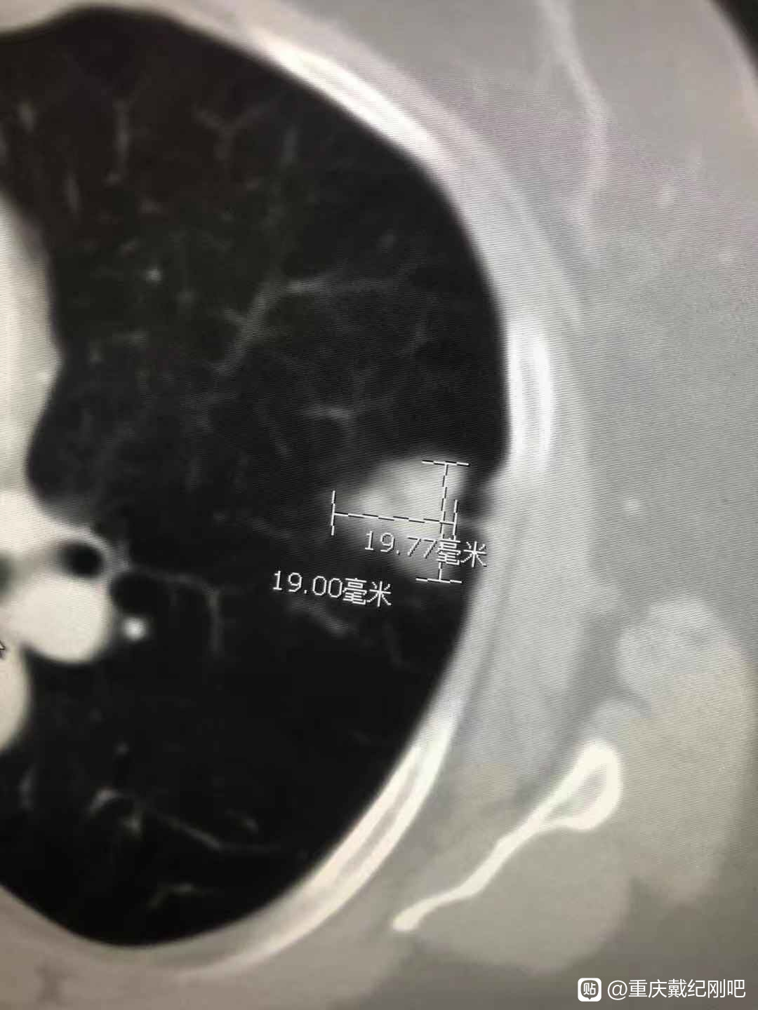 肺癌晚期一副中药活了五年真的吗,一天要三千块以上的治疗费