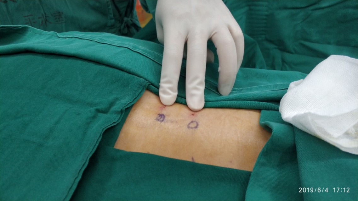 腰痛扎小针刀行吗,腰痛针灸需要吃药嘛