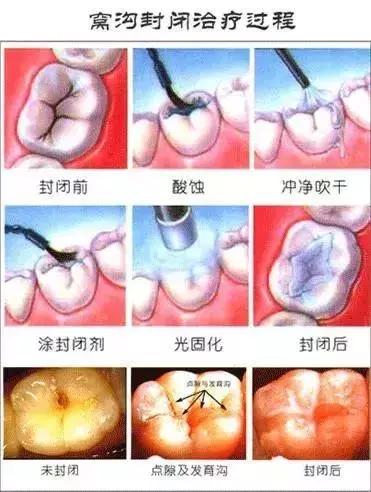 预防儿童蛀牙可打针预防吗,预防蛀牙可做窝沟封闭