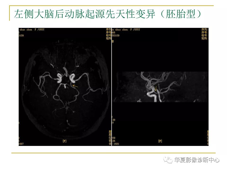 中国人脑立体定向mri应用解剖图谱,脑mri示意图