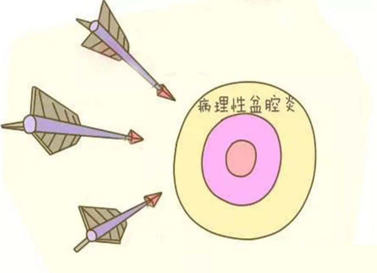 患上盆腔积液后怎么治,得了盆腔积液是输液还是吃药