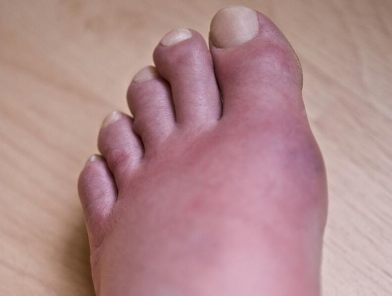 体检查出尿酸高该怎么办,体检发现尿酸高怎么办