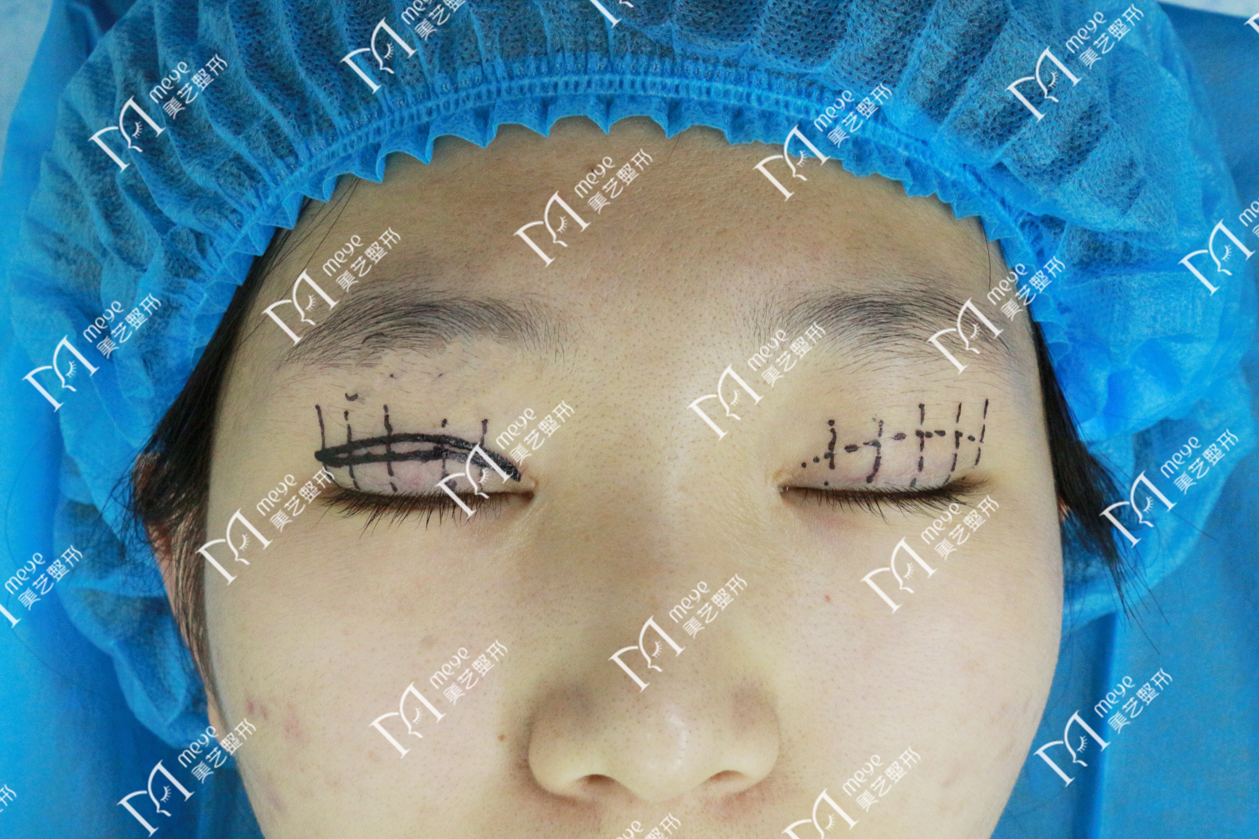 单眼上睑下垂修复术,上睑下垂眼睛修复手术成功率高吗