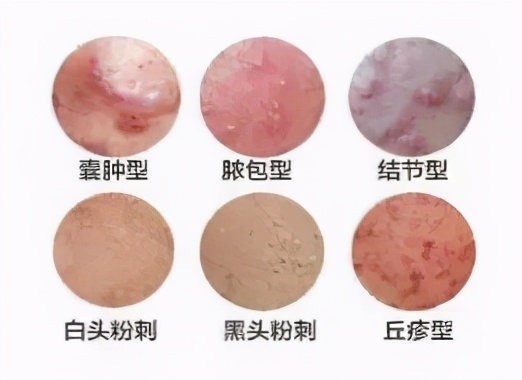 正在长痘能用水杨酸吗,还在长痘阶段能用维c精华吗