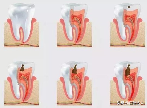 种不了种植牙还有其它办法吗,一直犹豫种牙还是镶牙