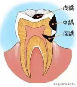 牙齿龋坏补牙多少钱,门牙龋坏了建议补牙还是做牙冠
