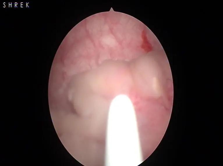 小结石有可能引起潜血吗,小结石引起的肾积水要紧吗