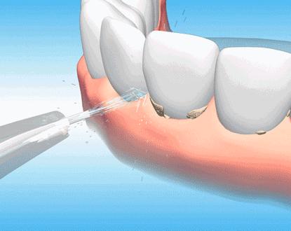 牙齿松动最佳补救方法种牙,牙齿松动怎么保护