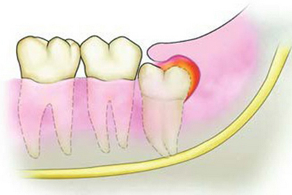 十大常见的口腔疾病,口腔疾病是最普遍的健康问题