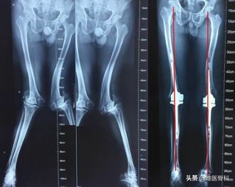 骨科医生o型腿怎么纠正,x型腿是盆骨还是膝盖问题