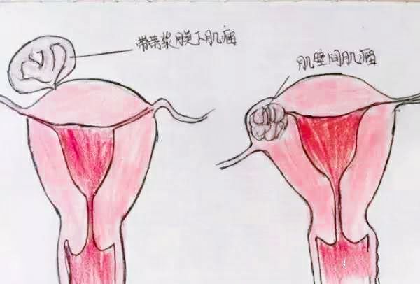 医生精美手绘图片大全,宫颈息肉红蓝铅笔手绘图