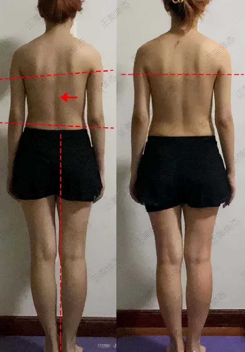 瑜伽高低肩矫正训练动作,偏瘫高低肩矫正训练动作