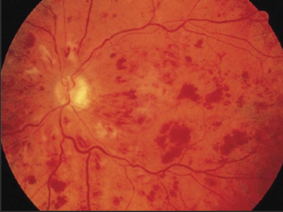 糖尿病不为人知的六大秘密视频,糖尿病血管病变科普视频