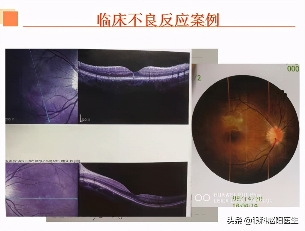 近视眼轴缩短什么原因,缩短眼间距的方法