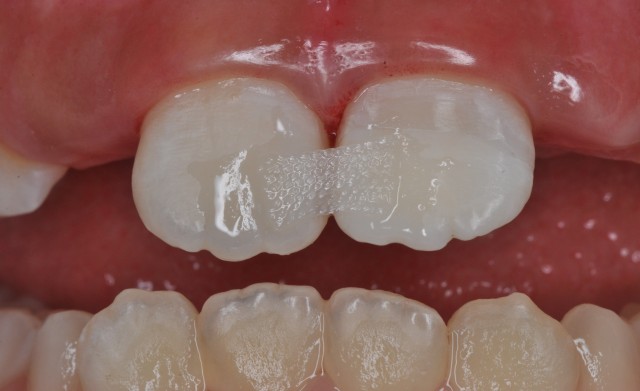 牙拔掉后扔掉还是留着,牙折断还能接回去吗