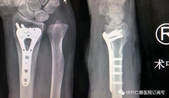 85岁老太摔倒被扶,八旬老太摔骨折