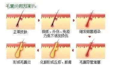 疙瘩一样的毛囊炎反复发作,毛囊炎凸起硬疙瘩跟痤疮的区别
