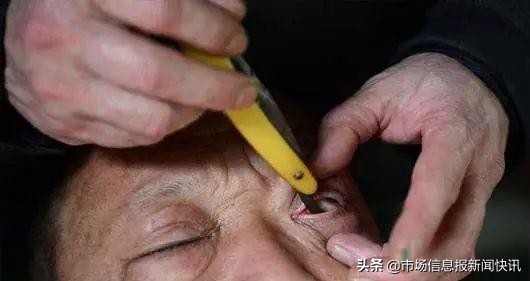 成都刀锋洗眼洗出虫子,刀锋洗眼可以做吗