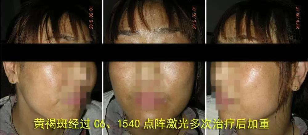 褐青斑怎么治疗最有效果,褐青斑有哪些治疗方法