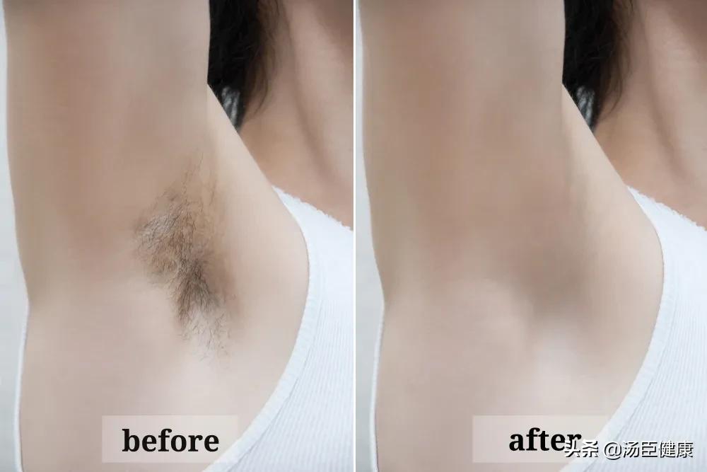 脱毛仪脱毛和激光脱毛哪个好,脱毛仪脱毛方案