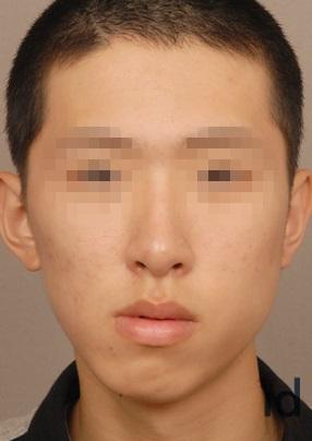 打瘦脸针有什么副作用,咬肌发达打瘦脸针有什么副作用吗