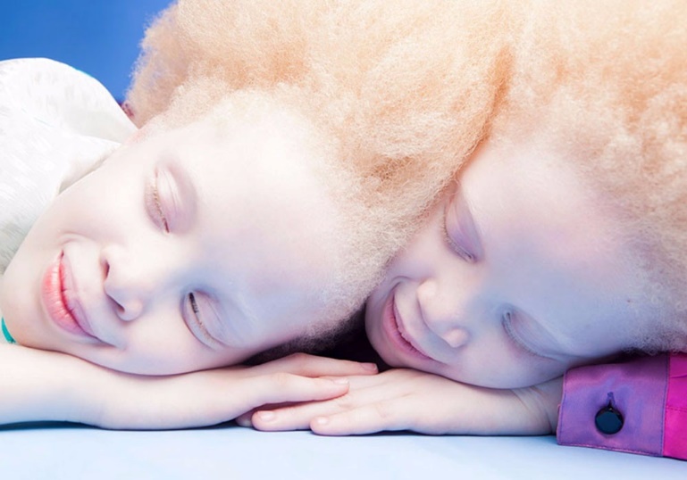 得了白化病的黑人，在百年前的美国，被迫出演畸形秀、被残忍猎杀