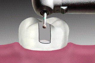 上火牙齿松动一咬就疼吃什么药,上火牙齿松动发软用什么药