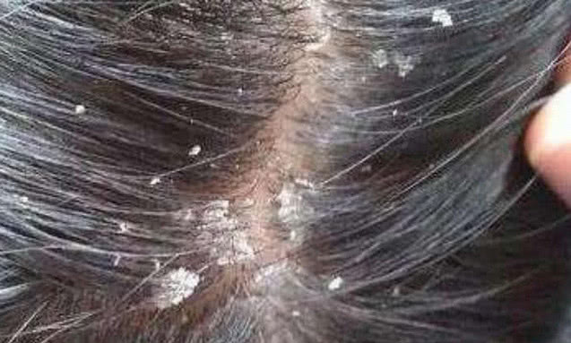 头皮银屑病建议多久洗一次头,头屑严重中医怎么处理