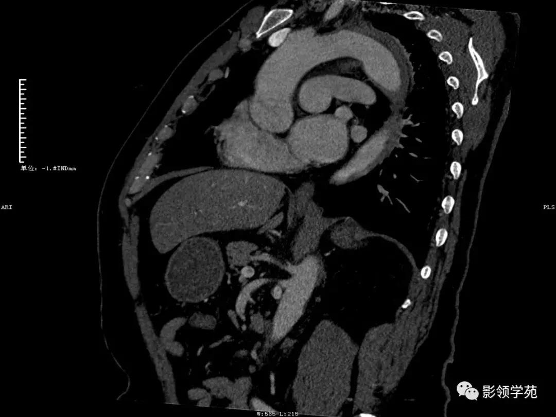 主动脉壁间血肿护理查房,主动脉夹层和壁间血肿图片