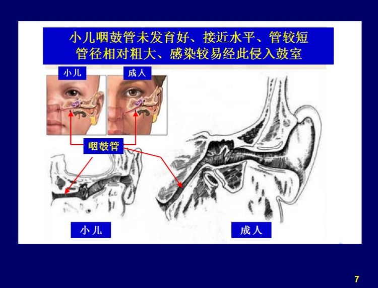 儿童分泌性中耳炎最佳治疗方法,儿童分泌性中耳炎文献