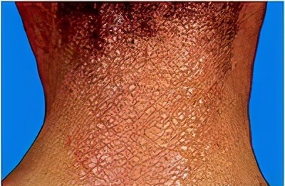 神经性皮炎反复发作，怎样才能摆脱它？