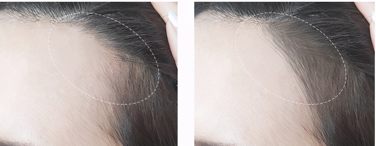 发际线高显老怎么办,发际线高最简单的补救方法