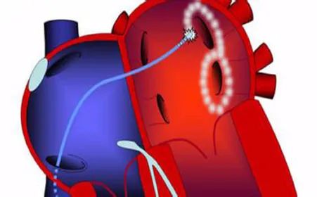 外科微创心脏房颤消融流程,心血管房颤治疗