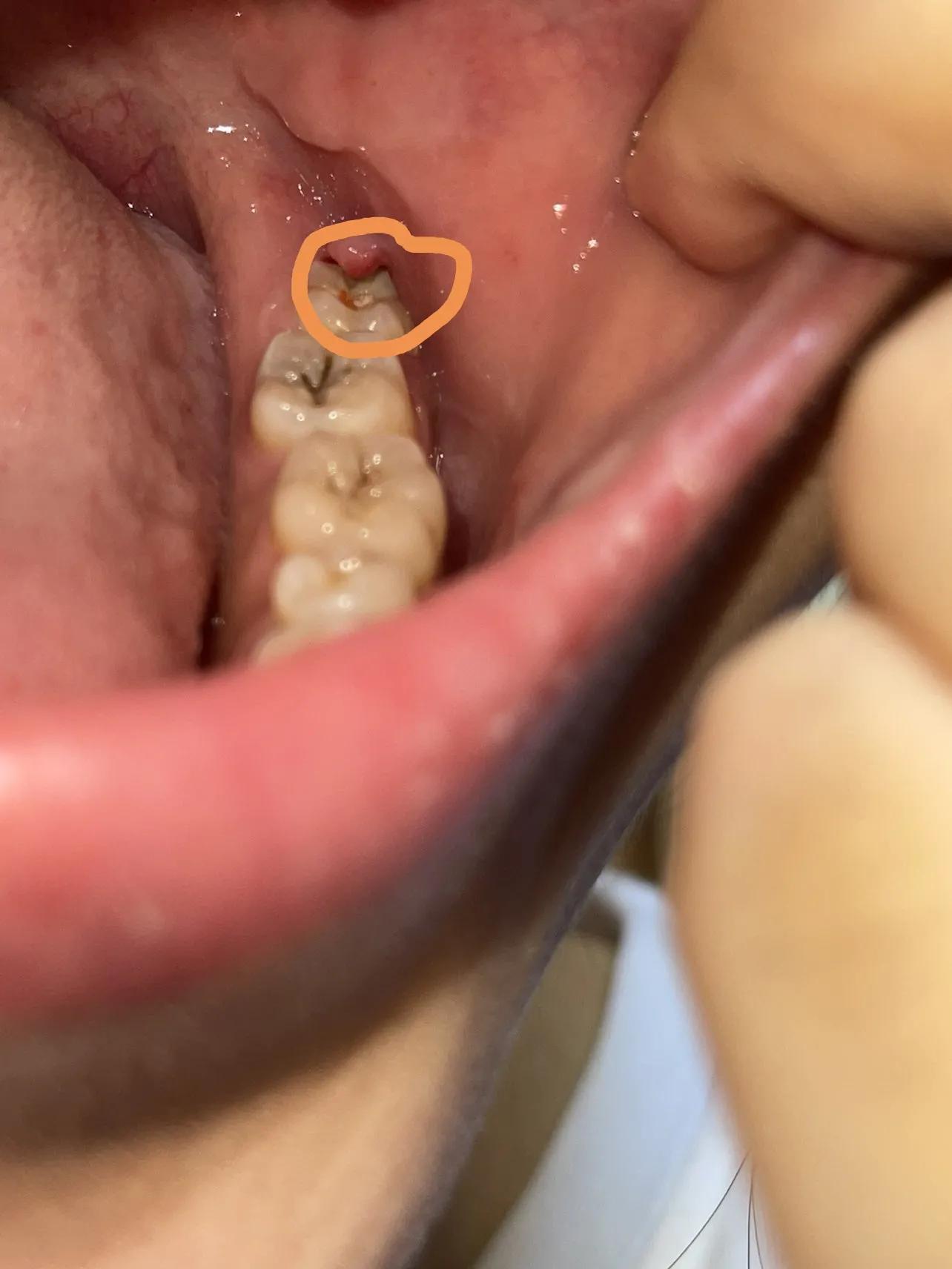 别让“上火”延误您保留牙齿的机会