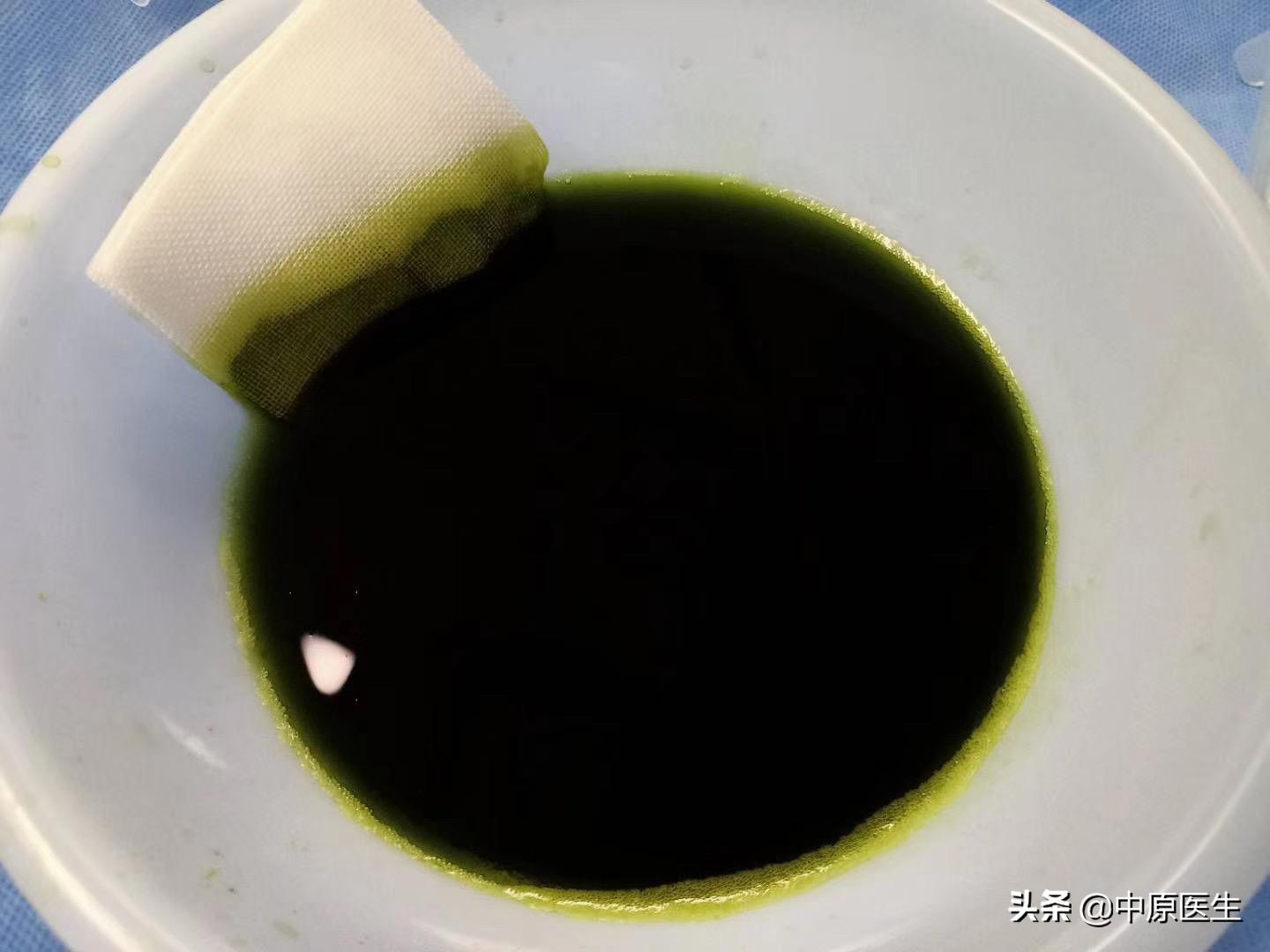 团队工作：老太太患黄疸规范治疗后仍高烧，转到介入科很快治好了