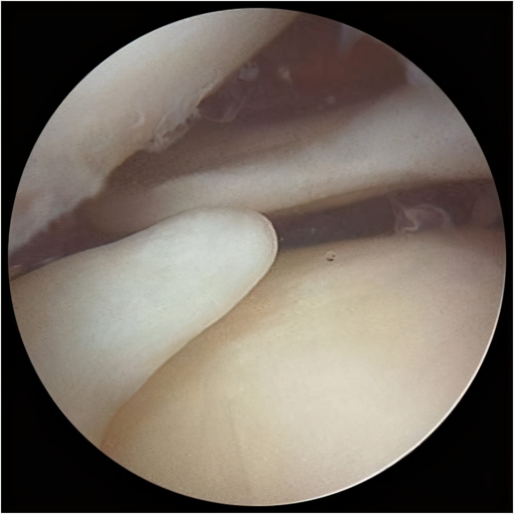 膝盖总是疼半月板损伤怎么治,膝盖一直痛是什么病