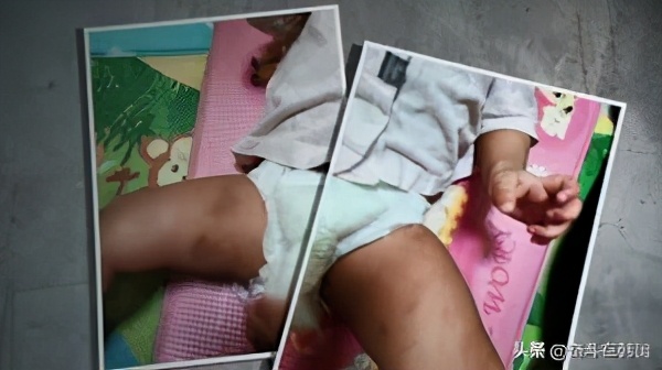 内脏破裂的小孩,腹腔脏器破裂的病人死亡的原因