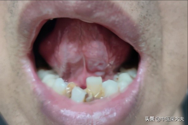 散偏汤实例——困扰20年的头痛，散偏汤加减5付见效