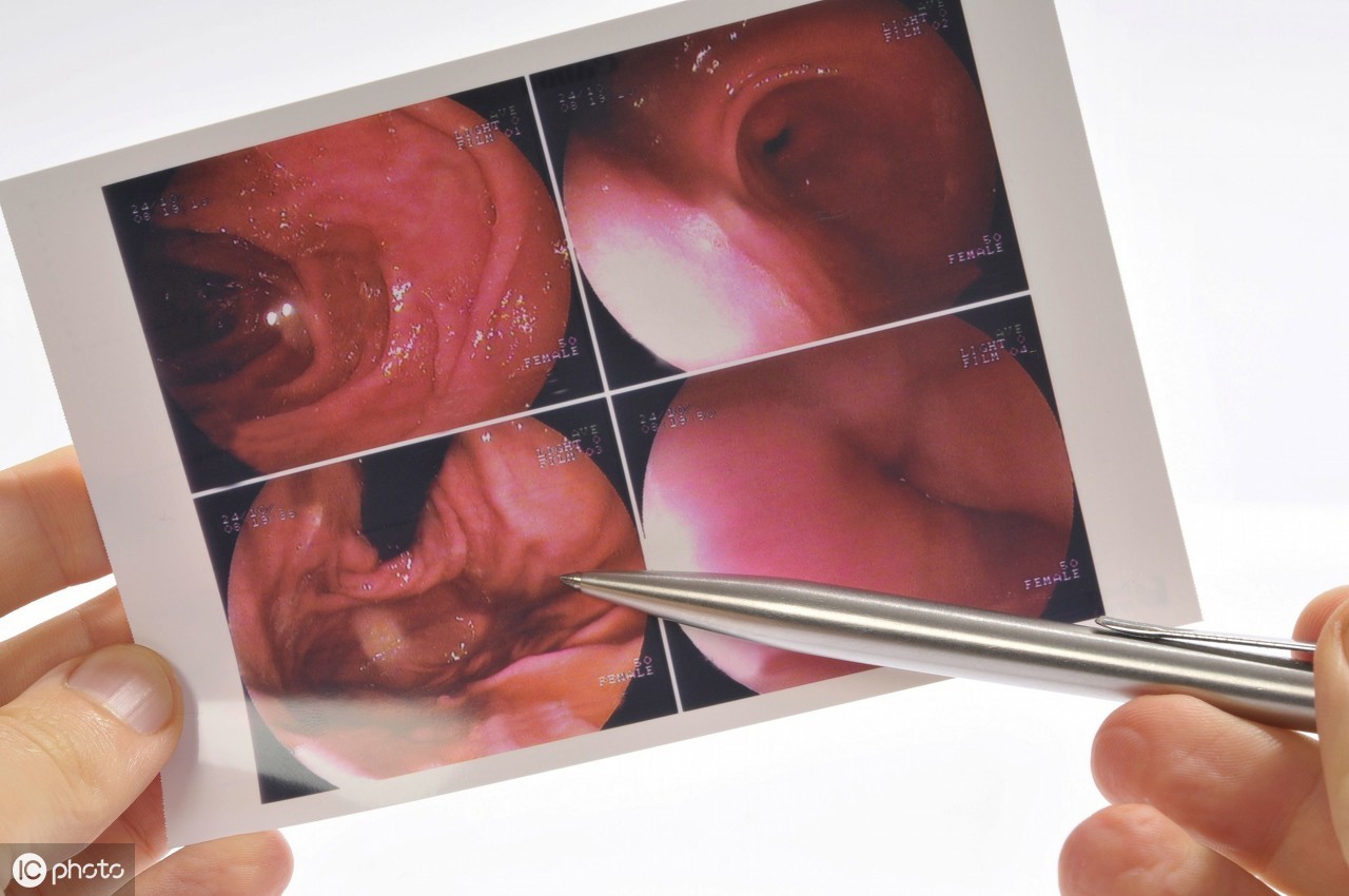 胃镜下黏膜粗糙会是胃癌吗,胃镜检查胃息肉会是胃癌吗