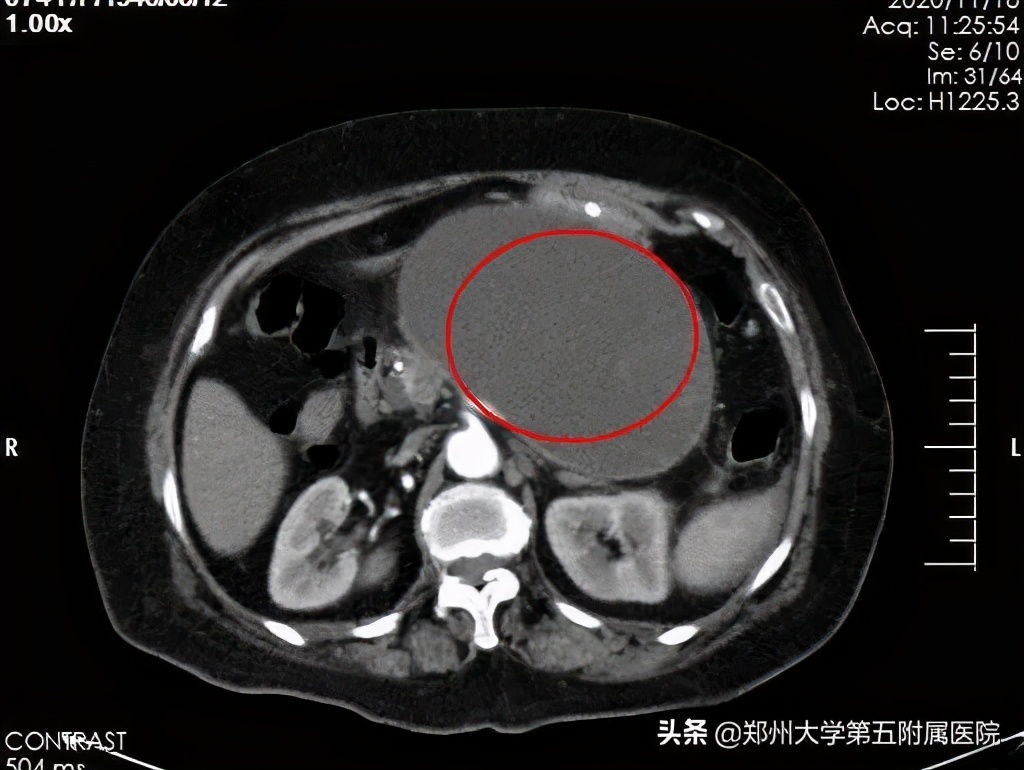 超声内镜下胰腺囊肿穿刺引流术,超声内镜下胰腺囊肿手术