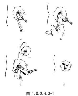 俗话说十人九痔真是那么回事吗,痔疮到底是个啥为什么说十人九痔