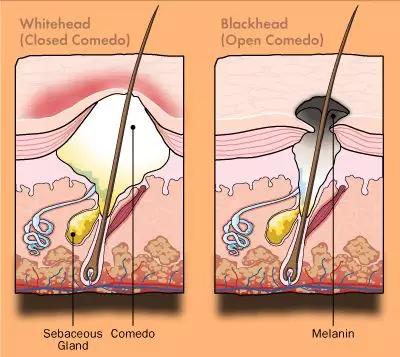 长闭口粉刺黑头的正确消除方法,脸上的粉刺黑头小疙瘩怎么去
