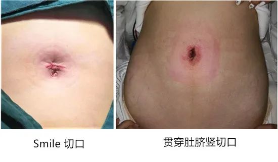 单孔腹腔镜和微创区别,单孔腹腔镜庆松微创