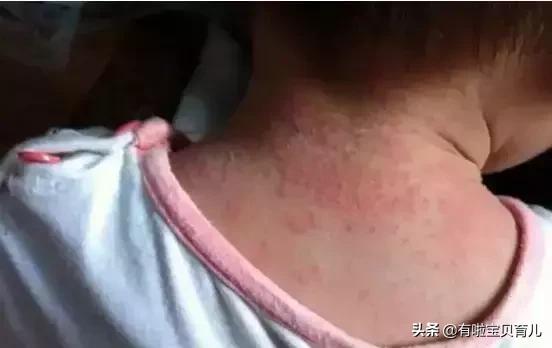 多图！热疹、湿疹、*麻疹荨**、幼儿急疹、水痘…区别和护理