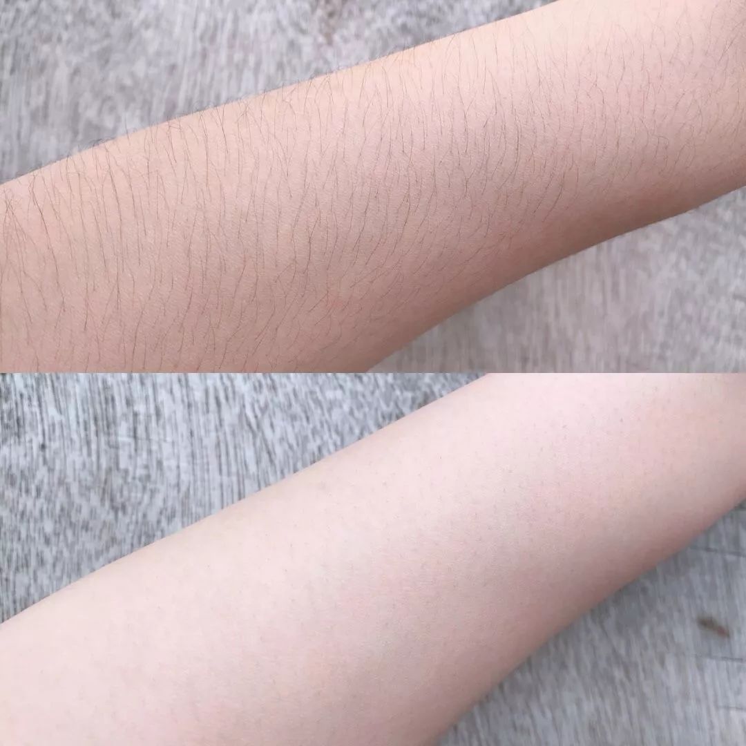 脱毛方法排行榜第一名,目前最好的脱毛技术