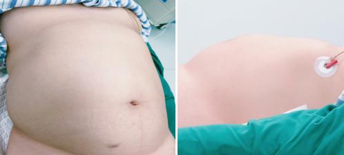 卵巢肿瘤新技术,卵巢恶性巨大肿瘤手术