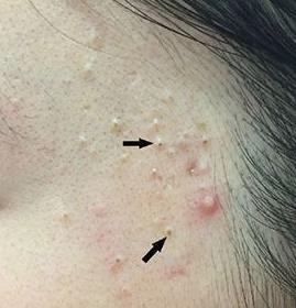 痘痘防止复发的方法是什么,反复长痘怎么解决改善痘痘肌