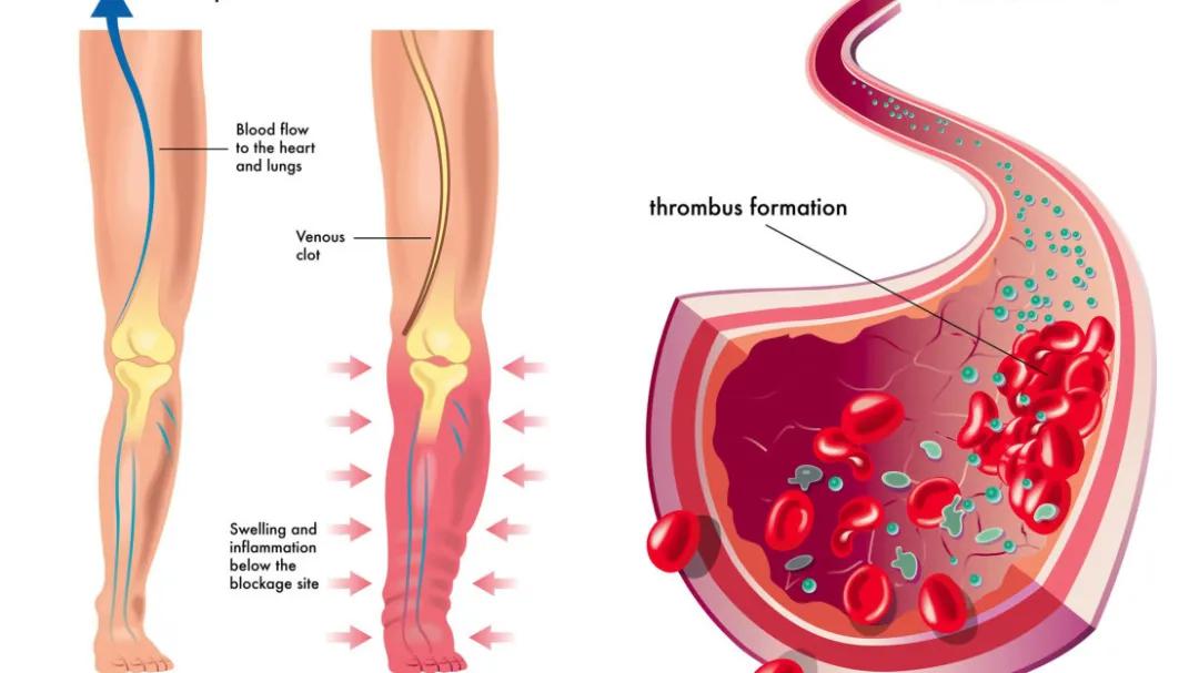 清除血液垃圾打什么针,老年人定期输液对身体好吗