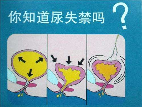 怎么判断自己是否有漏尿,科普漏尿原因