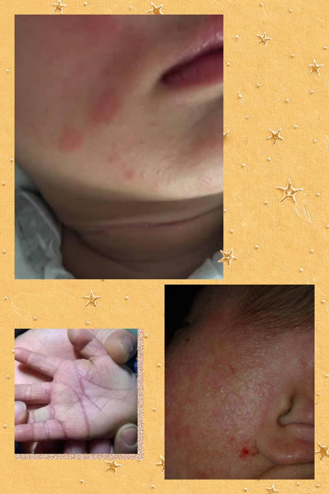 湿疹泛红粗糙干裂，这些宝宝常见的皮肤问题，怎么才能解决？